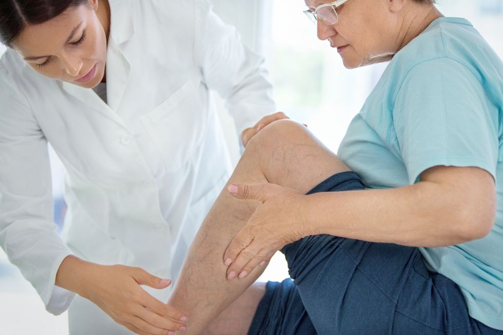 What Works Best Against Varicose Veins?