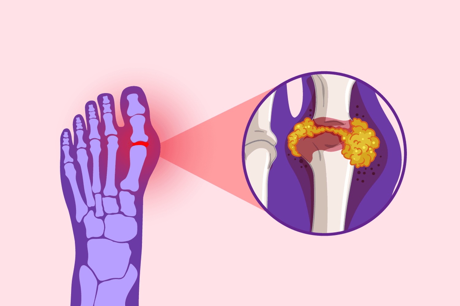 What You Need to Know About Gout in Women