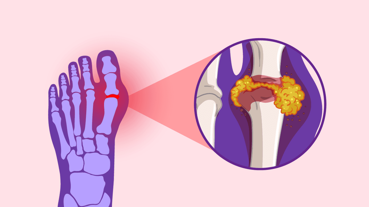 What You Need to Know About Gout in Women