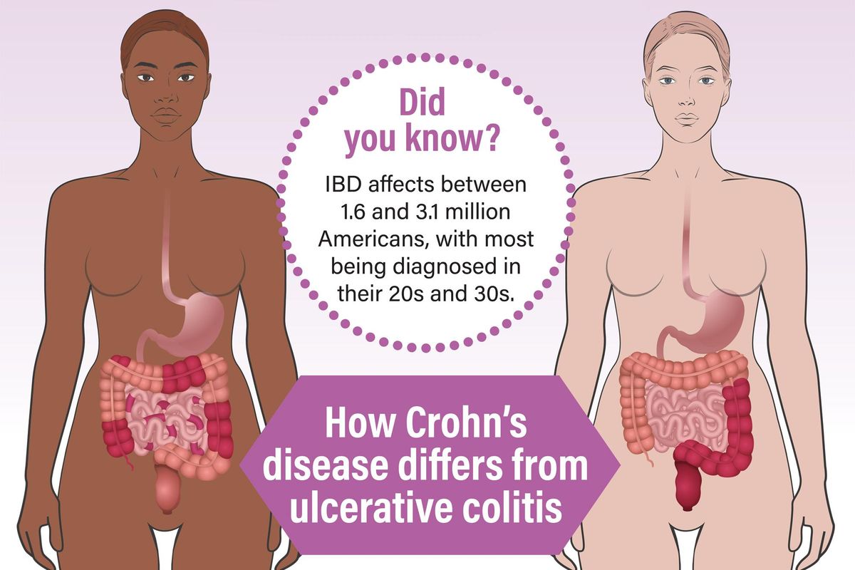 What You Need to Know About Inflammatory Bowel Disease