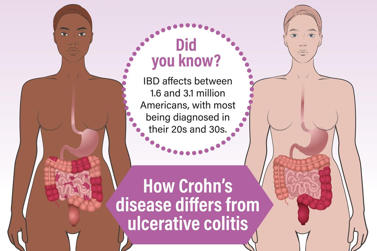 What You Need to Know About Inflammatory Bowel Disease