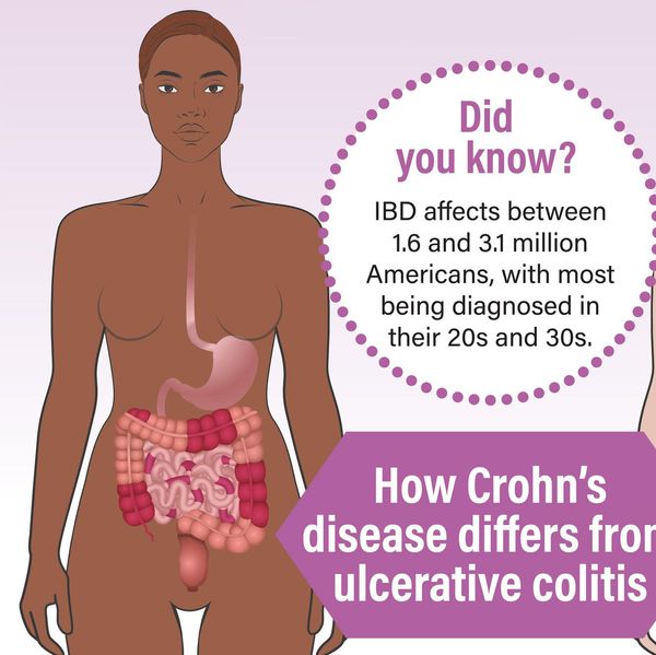 What You Need to Know About Inflammatory Bowel Disease