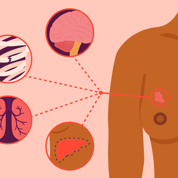 Where Metastatic Breast Cancer Can Spread in the Body