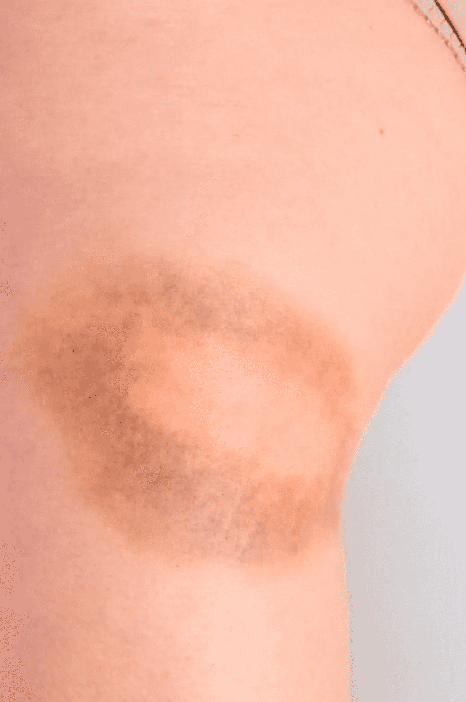 5 Signs and Symptoms of von Willebrand Disease