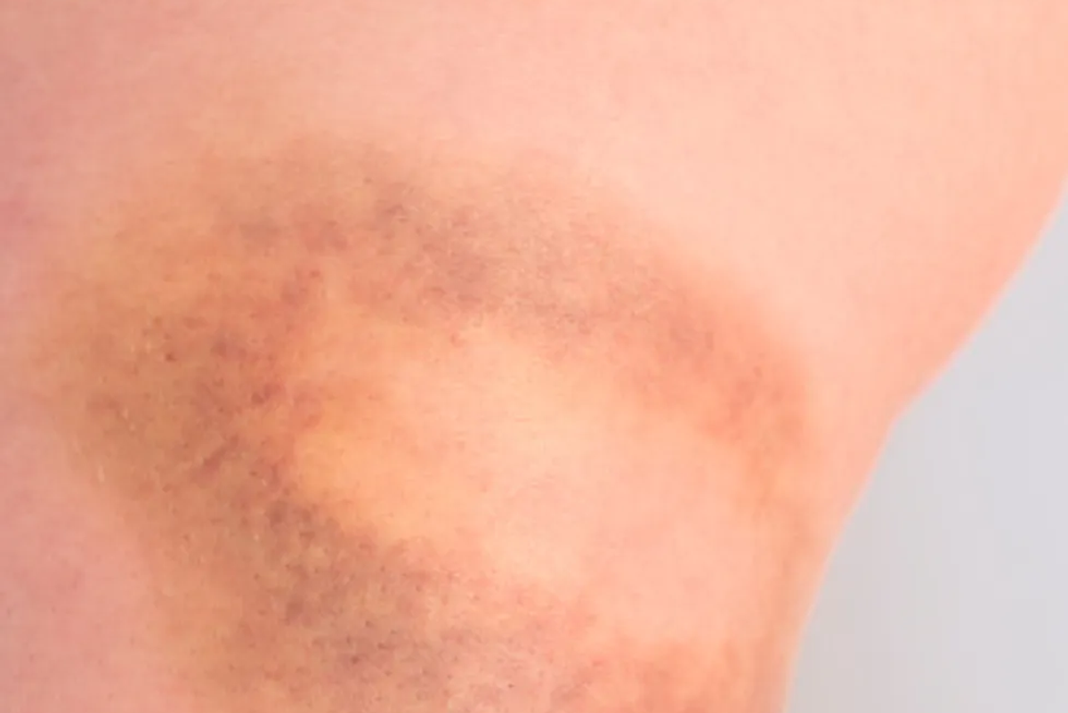 Willebrand disease (VWD) bruise