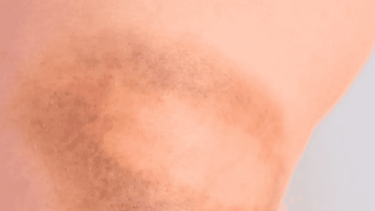 5 Signs and Symptoms of von Willebrand Disease