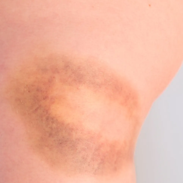 Willebrand disease (VWD) bruise