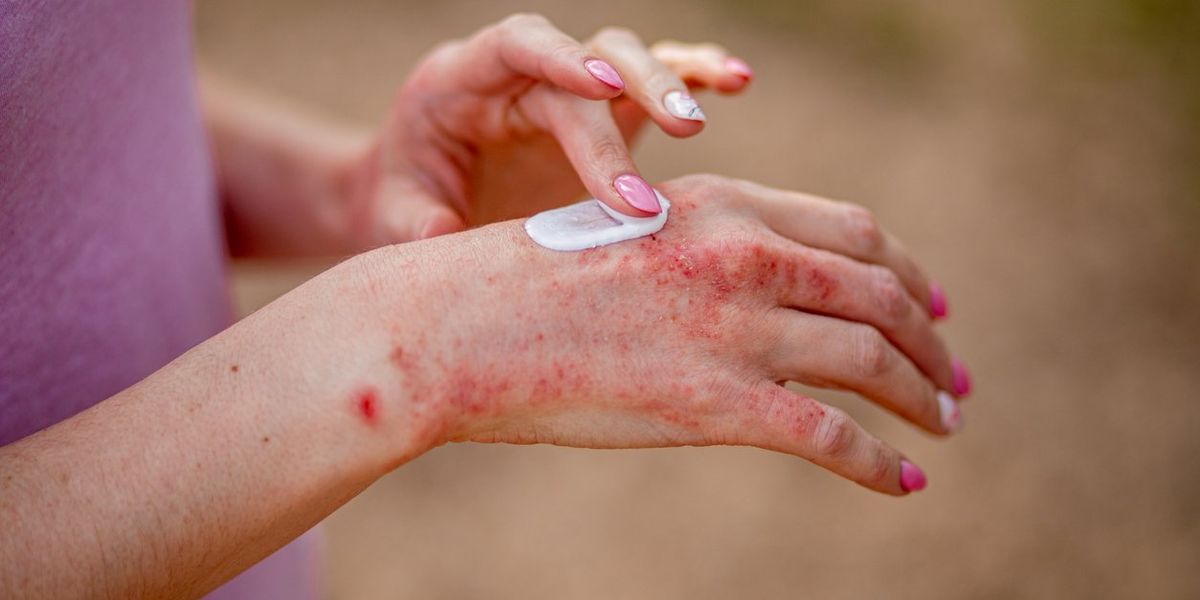 How Psoriasis Affects Your Overall Well-Being