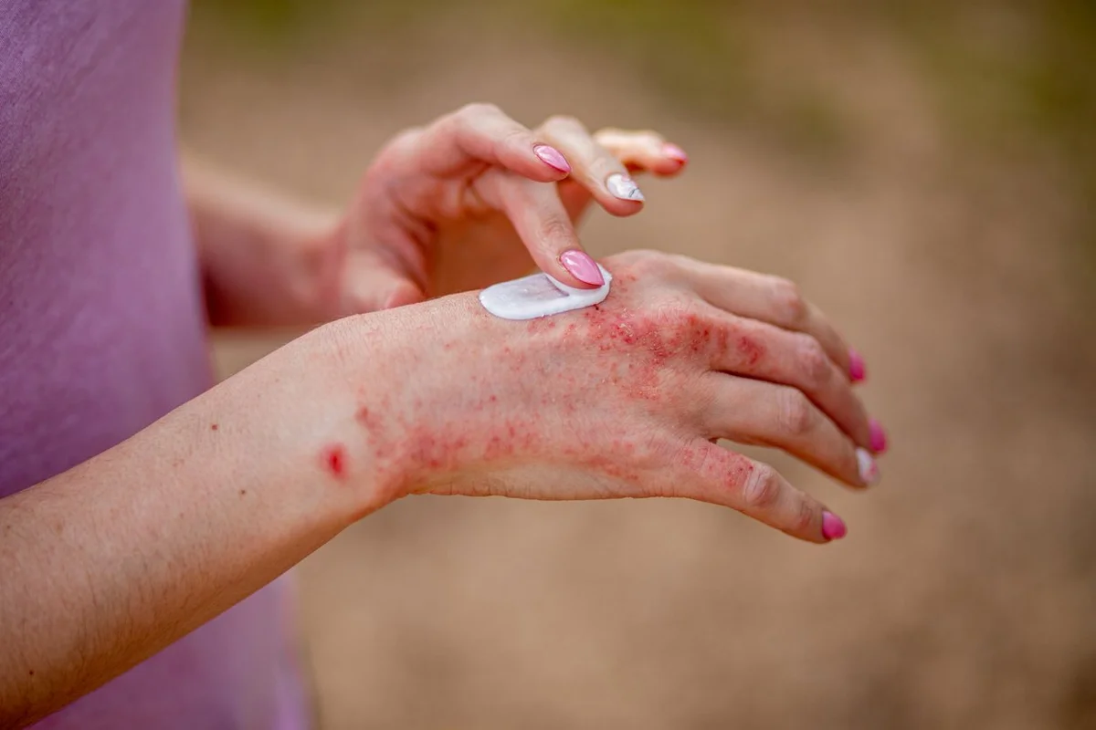 woman applying ointment on her hands in the treatment of psoriasis