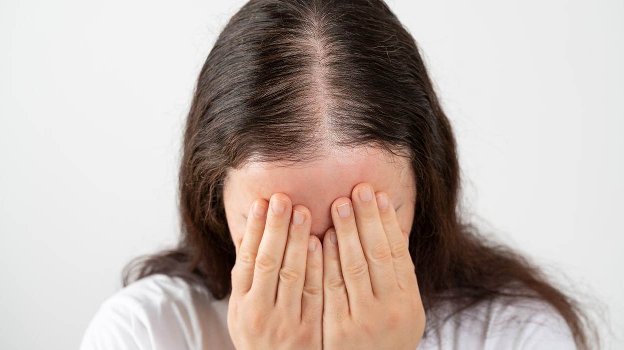 Hair Loss in Women