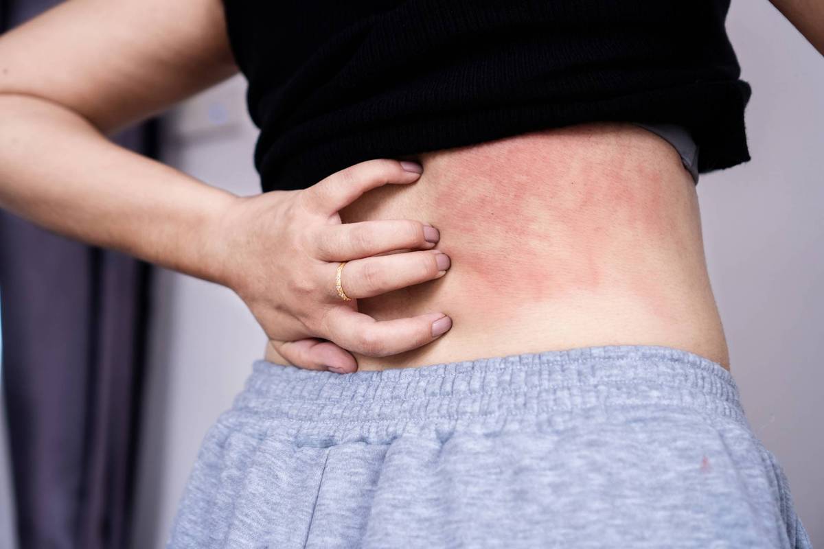 woman suffering from skin disease hand scratching on her back