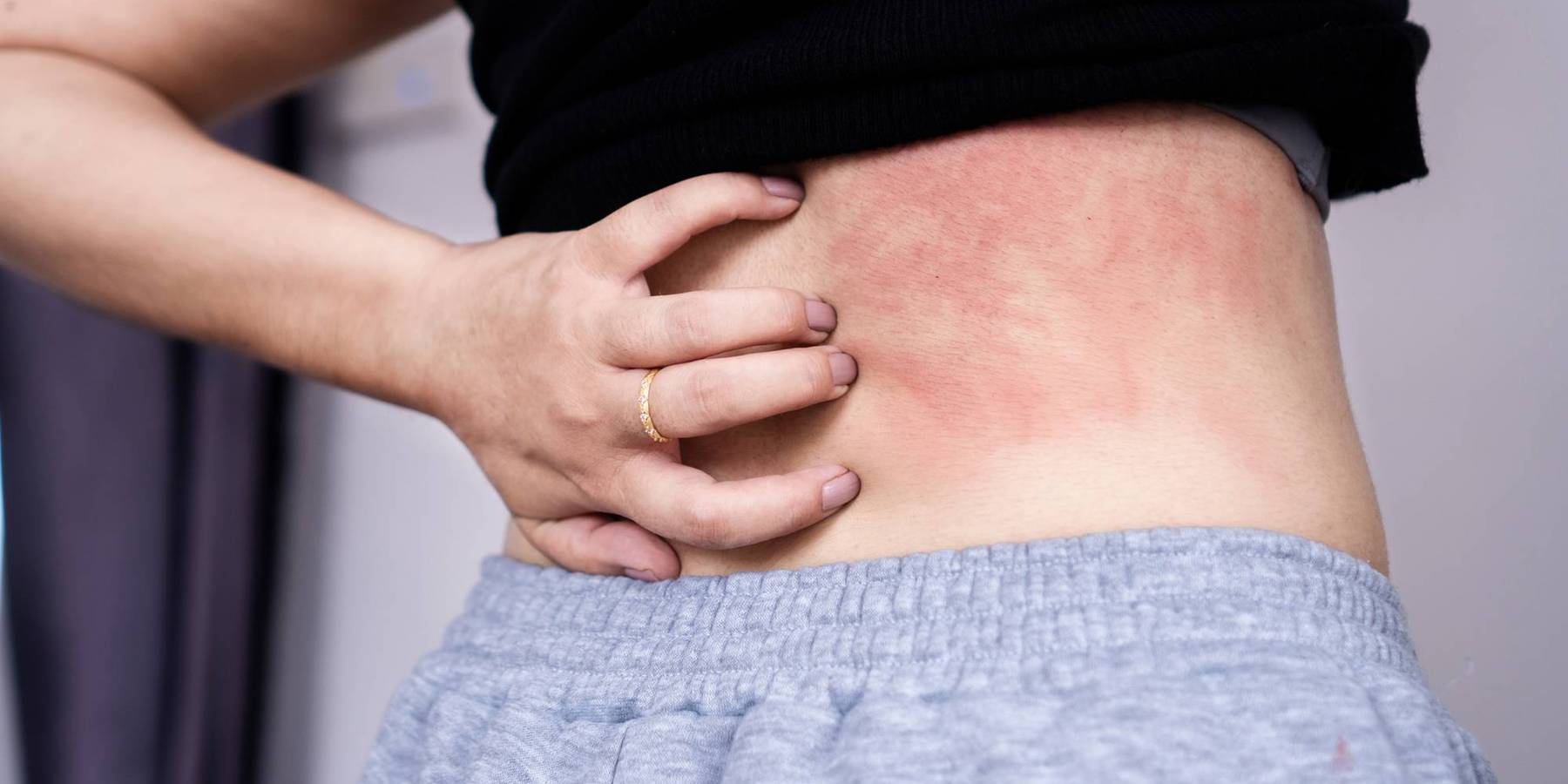 woman suffering from skin disease hand scratching on her back