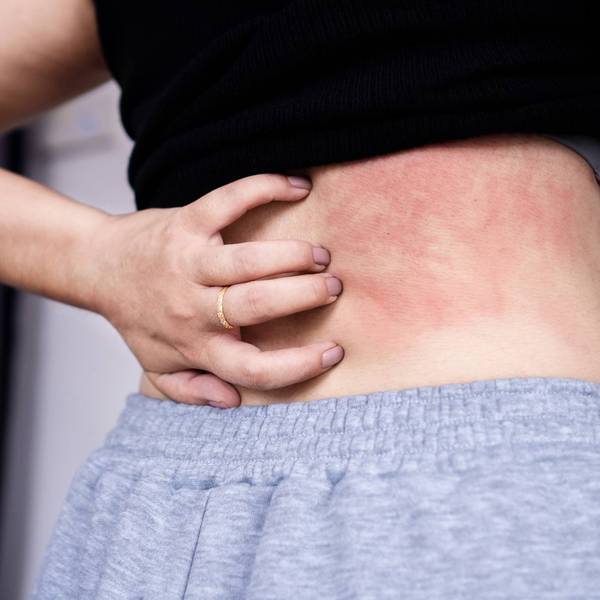 woman suffering from skin disease hand scratching on her back