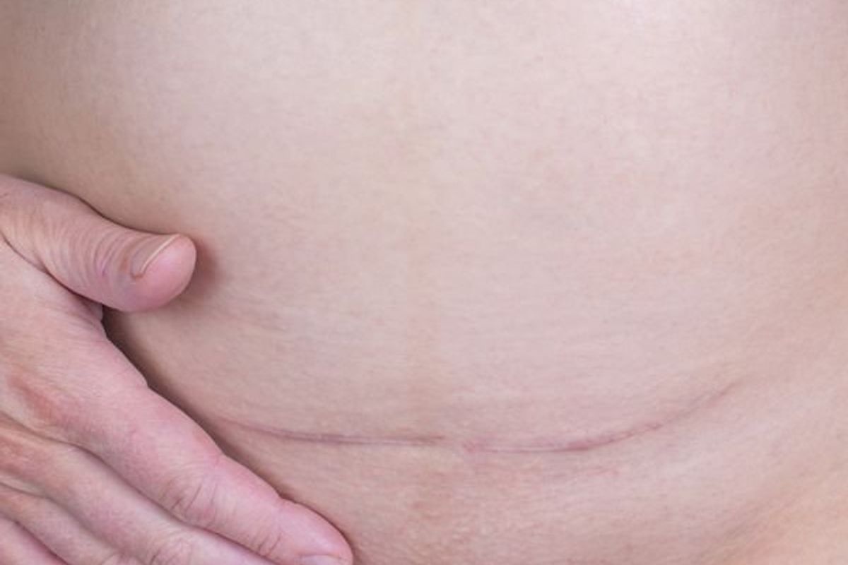 woman with a c-section scar