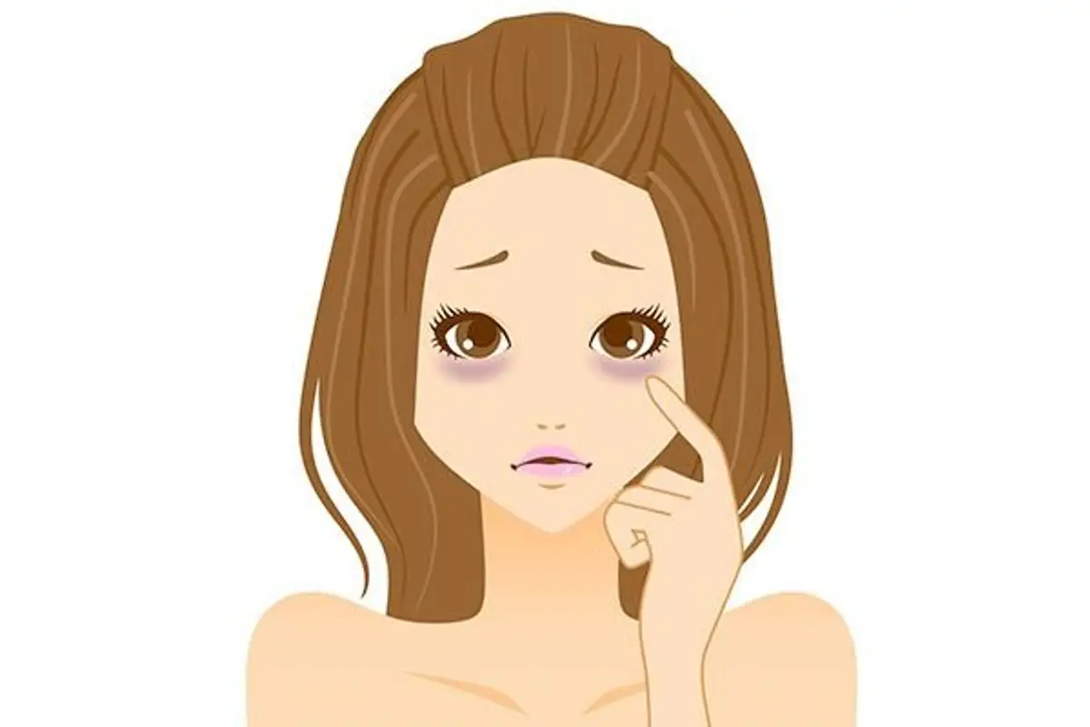 woman with dark under-eye circles