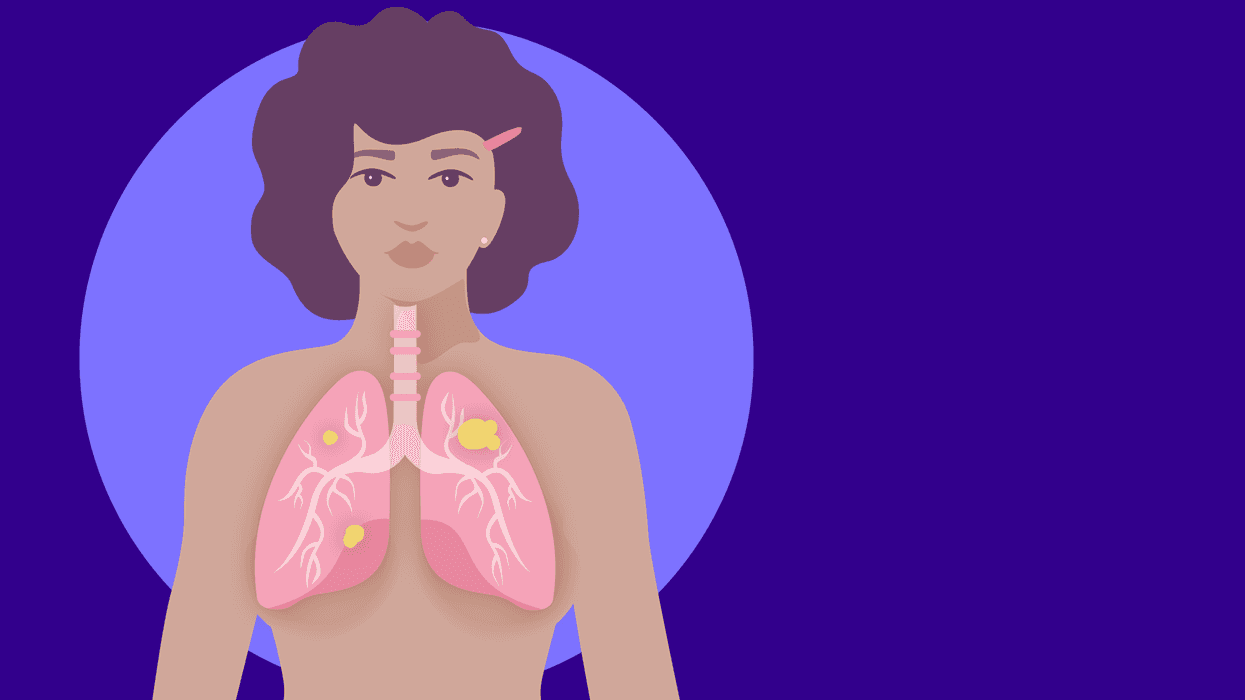 Women Who Have Never Smoked Can Get Lung Cancer