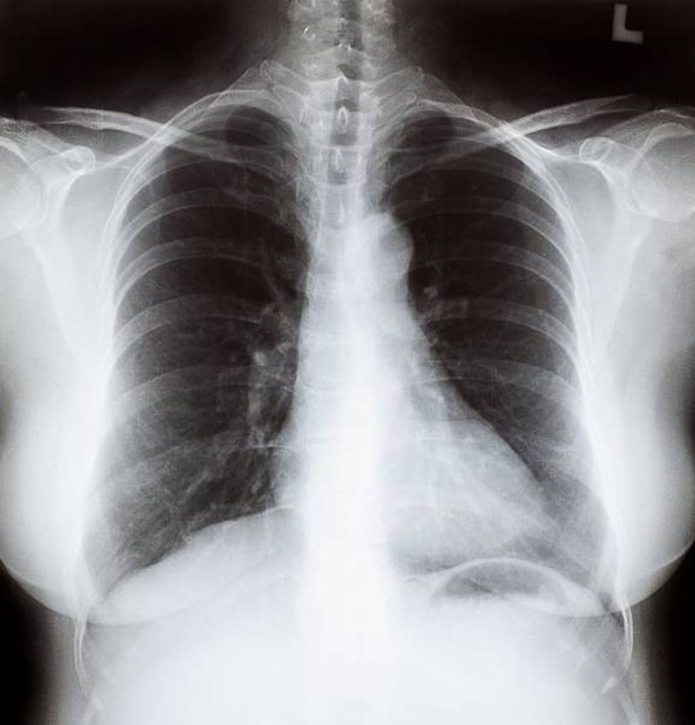 X-Ray Image of women chest
