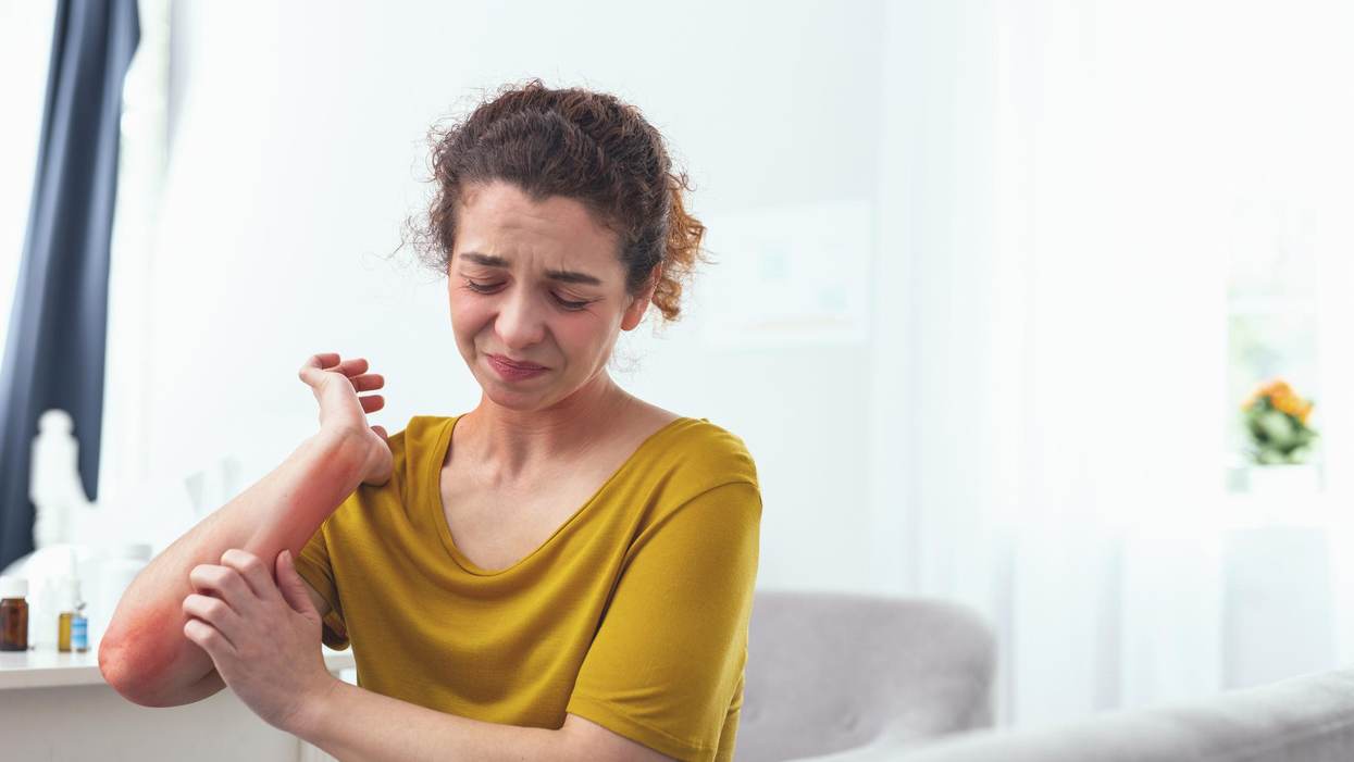Atopic Dermatitis Shows Up on Your Skin, but Its Effects Go Much Deeper